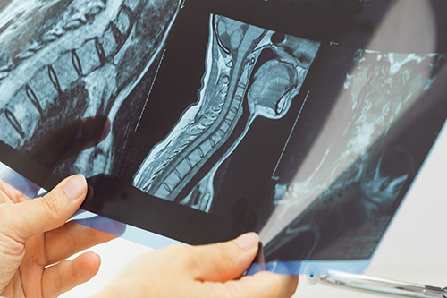 Close-up of hands holding and examining MRI scans showing detailed cross-sectional images of the human spine and neck.